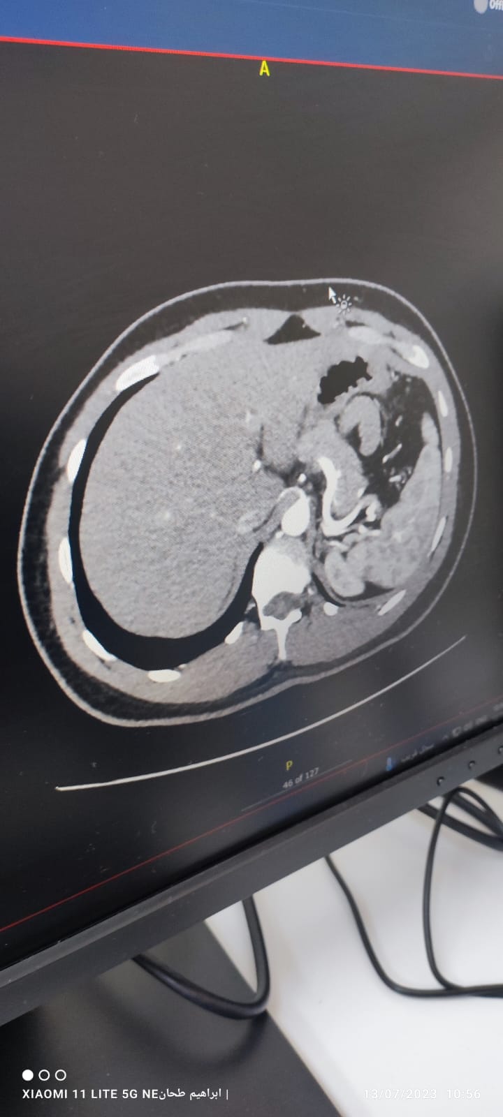 CT Scan of Liver Before Donation
